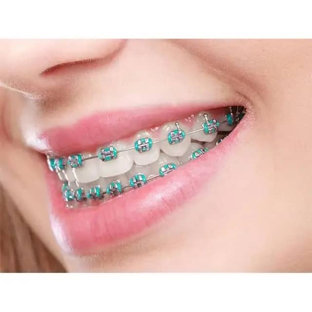 Appareil Dentaire Esthétique:Le Sourire Tendance qui Fait Craquer Tout le Monde